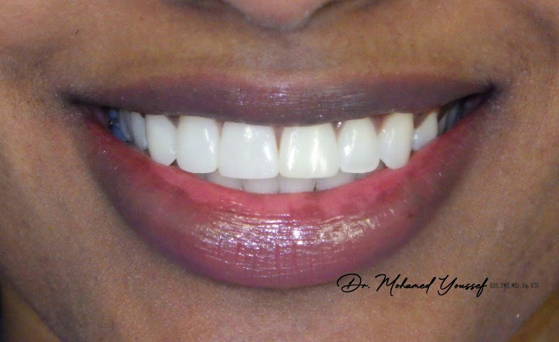 Dental Implants Montreal | Dr. Mohamed Youssef